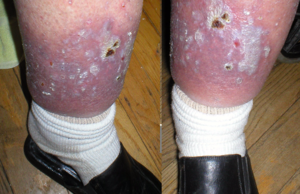 Example of a skin ulcer on the left leg.